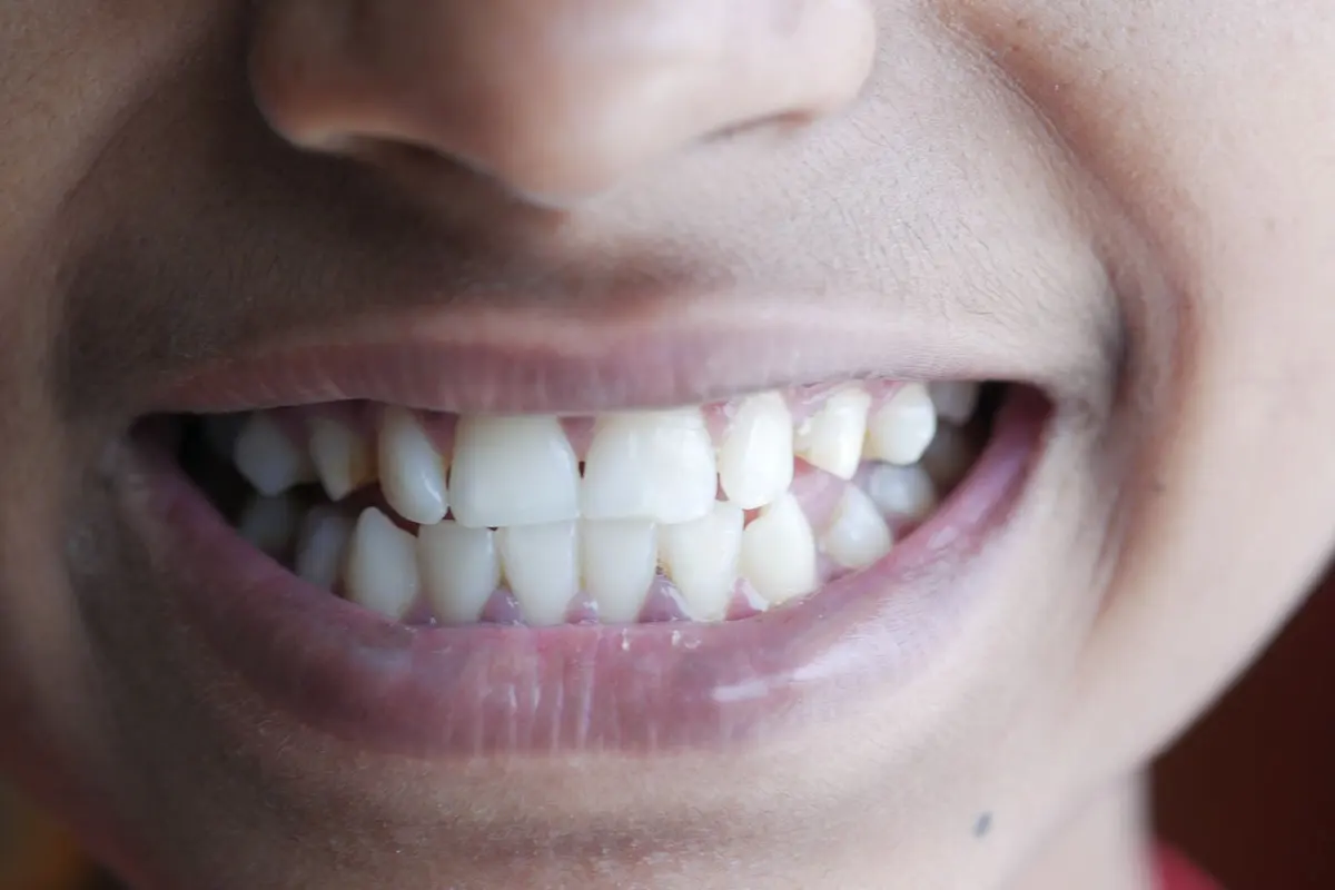 Dental Veneers